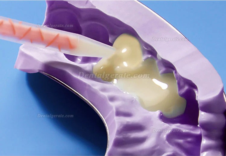 Dental Provisorische Kronen- und Br&uuml;ckenmaterialien A1 / A2 / A3 mit 10 Mischkan&uuml;len